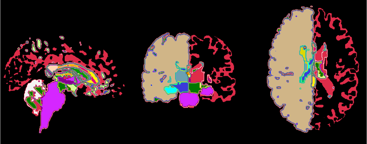 Labelled segmentation image overlaid on the anatomical reference image.