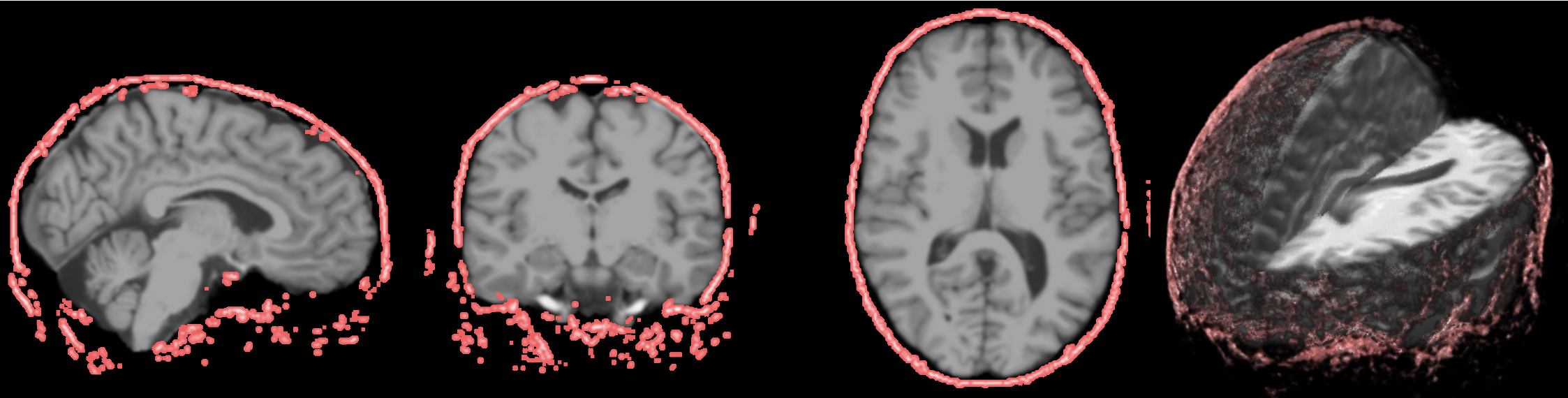 Brain extraction result displayed as an overlay on the anatomical reference image.