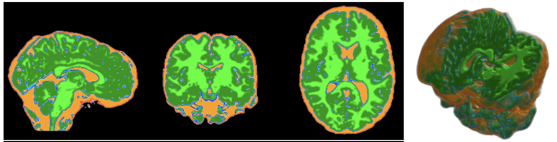 FAST hard segmentation.